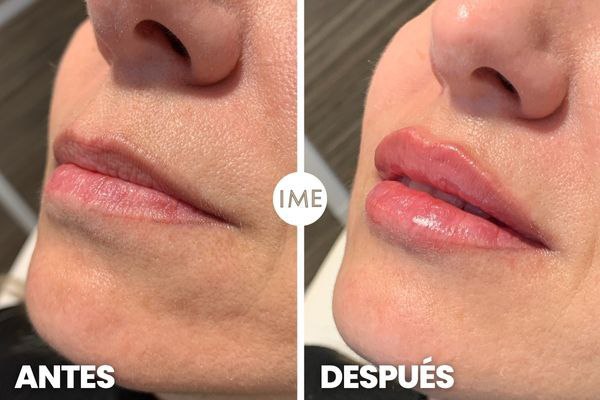 Antes y Después Botox